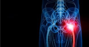 نورالژی پودندال؛ درد مزمن لگن و راه‌های درمان آن